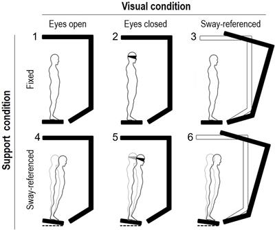 Balance impairment in myotonic dystrophy type 1: Dynamic posturography suggests the coexistence of a proprioceptive and vestibular deficit